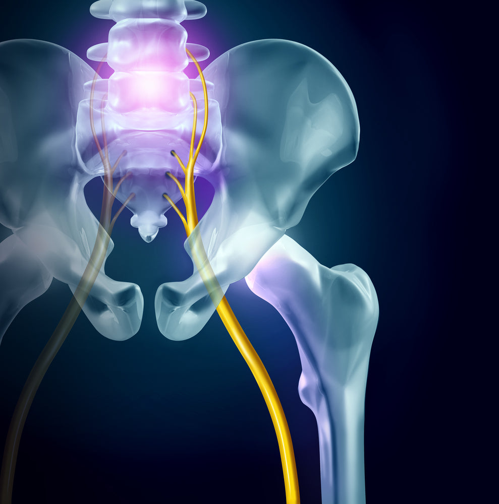 5 Effective Sciatica Relief Tools You NEED TODAY!!!