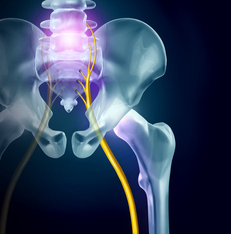 5 Effective Sciatica Relief Tools You NEED TODAY!!!